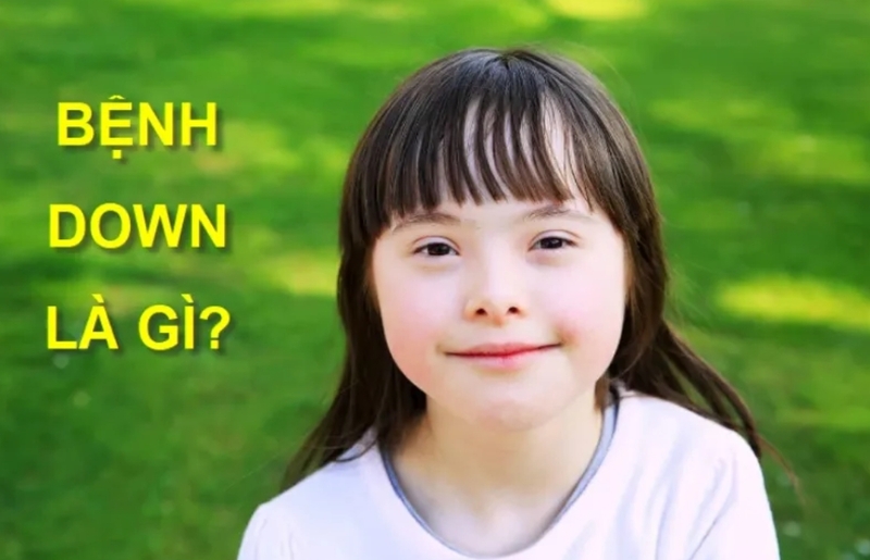 Bệnh Down là gì? Nguyên nhân, dấu hiệu và cách chăm sóc đúng