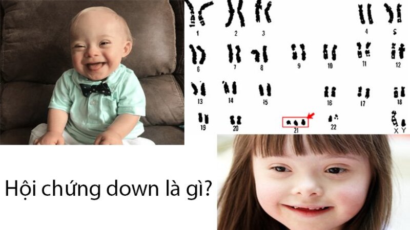 Bệnh Down chủ yếu xuất phát từ bất thường nhiễm sắc thể số 21, không phải do lỗi của cha mẹ. 