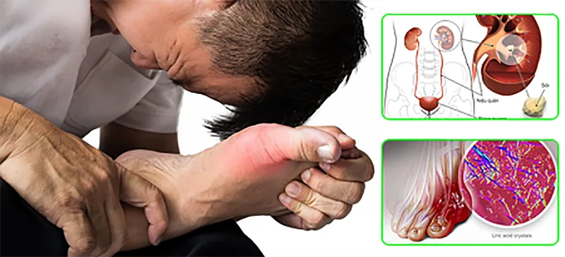Bệnh gout kiêng ăn gì