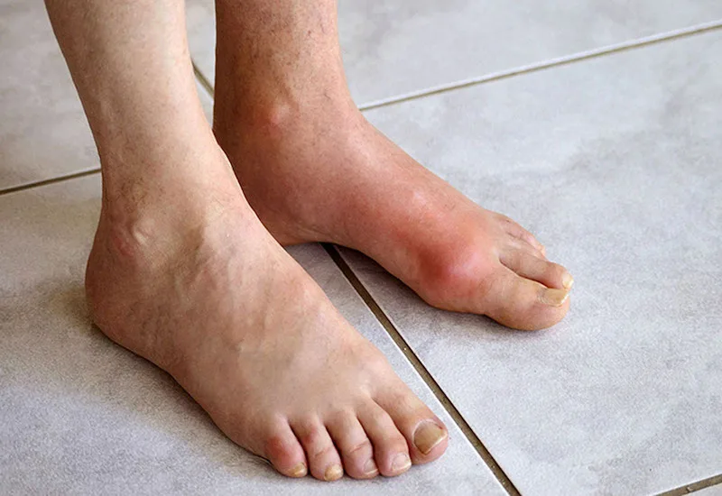 Bệnh gout kiêng ăn gì
